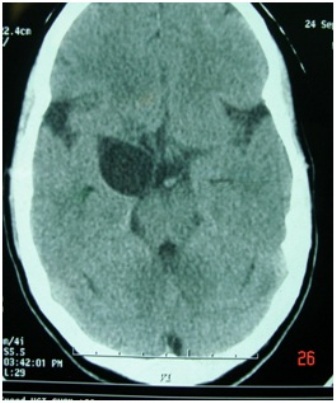 Figure-3: Suprasellar cyst with deep sylvian extension